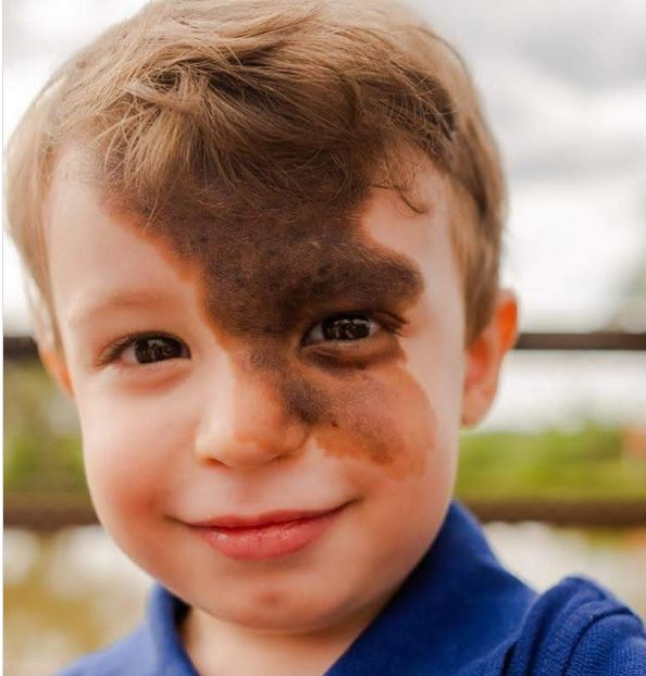The son was very shy of his birthmark. Then mom decided to show him in an original way that he is unique