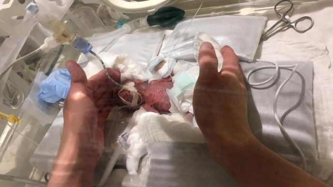 Doctors were leaving a tiny newborn, the size of a palm