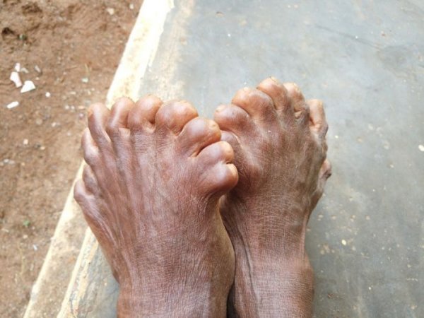She is a witch! Fellow villagers are afraid of a woman who has 31 fingers