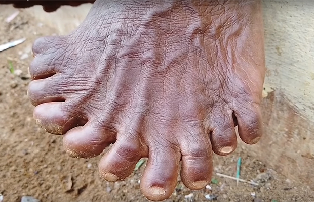 She is a witch! Fellow villagers are afraid of a woman who has 31 fingers