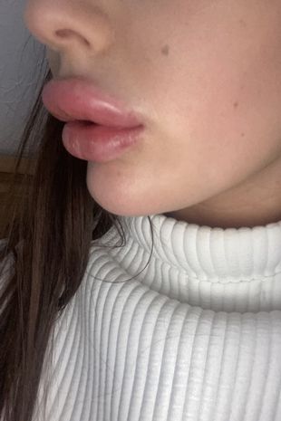 Lips ruined forever! The girl is embarrassed to show herself even to her beloved