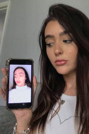 Lips ruined forever! The girl is embarrassed to show herself even to her beloved
