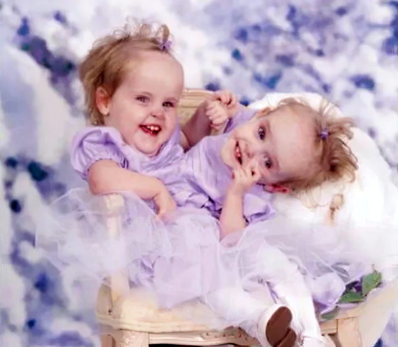 These Siamese twins were separated at 4 years old and are now 18 years old. How do they live now?
