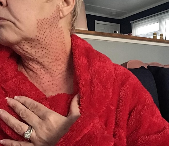The woman wanted to get rid of the second chin, but because of the unfortunate master she was covered with scars