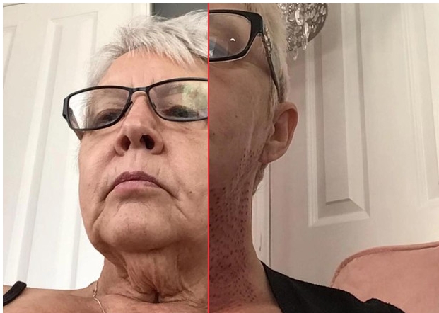 The woman wanted to get rid of the second chin, but because of the unfortunate master she was covered with scars