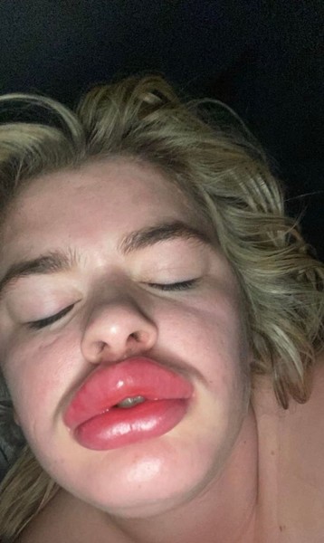 I could hide it with a mask! What does a girl with fish lips look like?