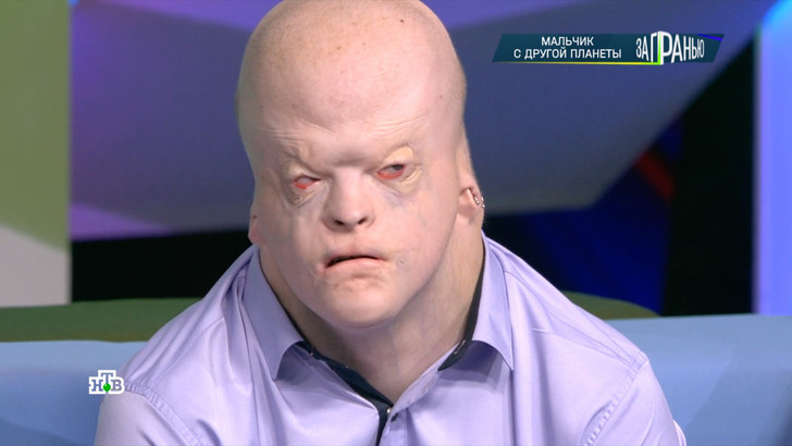 Alien visitor: how an 18 yearold boy with rare disease looks and lives