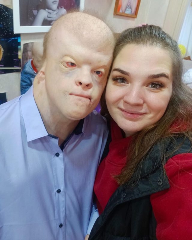 Alien visitor: how an 18 yearold boy with rare disease looks and lives