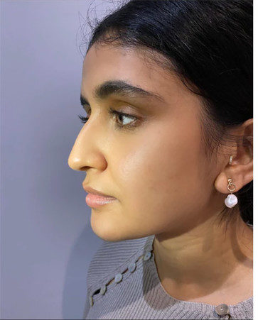 Rhinoplasty in 5 minutes! what the result of the procedure looks like: before and after photos that will amaze you