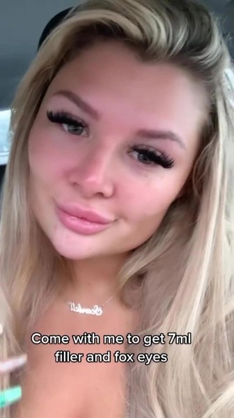 Plastic viсtim! 27 yearold girl was scared by the result after the introduction of the filler in the face