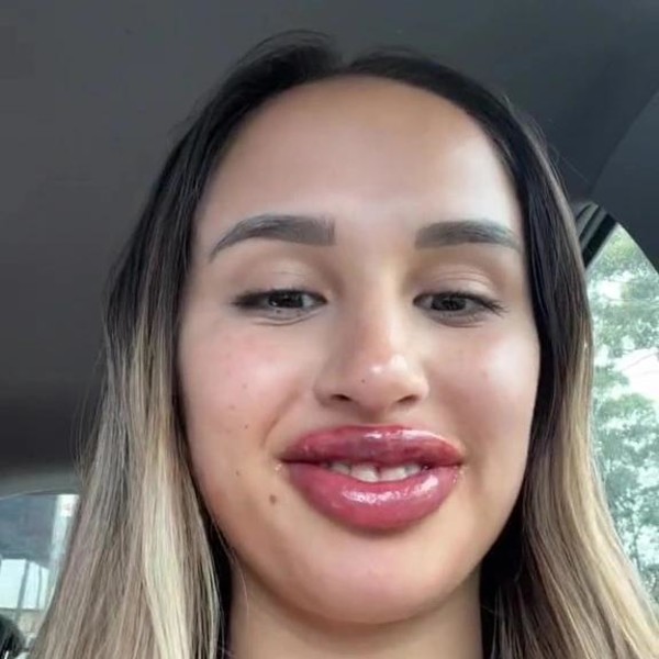 The girl made a tattoo of her lips, but as a result, she tripled them