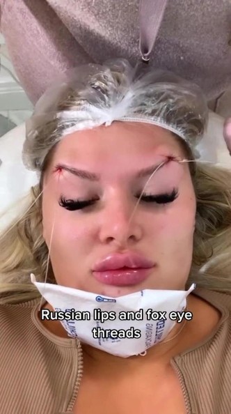 Plastic viсtim! 27 yearold girl was scared by the result after the introduction of the filler in the face