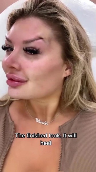 Plastic viсtim! 27 yearold girl was scared by the result after the introduction of the filler in the face