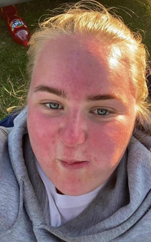 How an hour in the sun changed a woman's face beyond recognition