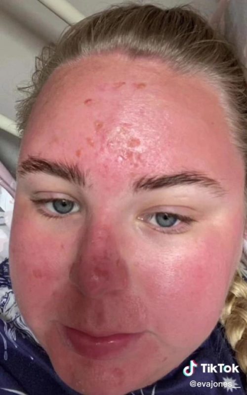 How an hour in the sun changed a woman's face beyond recognition