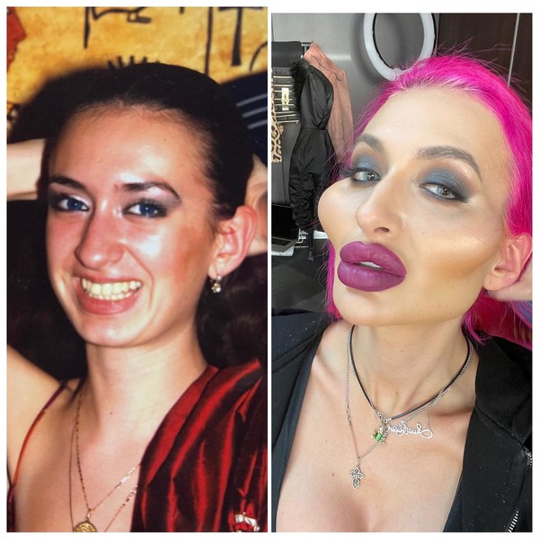 She can't stop! The model injects fillers in the cheeks and they will soon burst