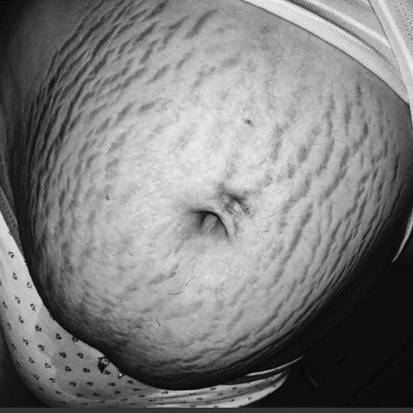 The belly is disfigured irrevocably! Photos of women who gave birth to twins