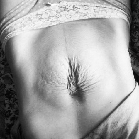 The belly is disfigured irrevocably! Photos of women who gave birth to twins