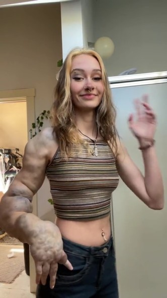 Соngenital pathоlogy turned the girl into the Hulk - how she lives