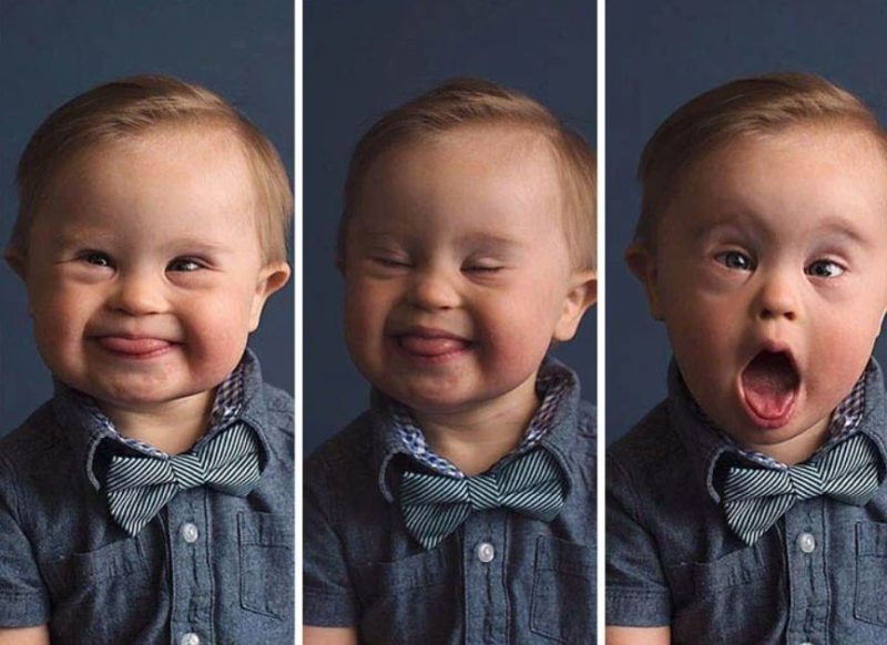 Serious health problems do not prevent this baby from being a model!