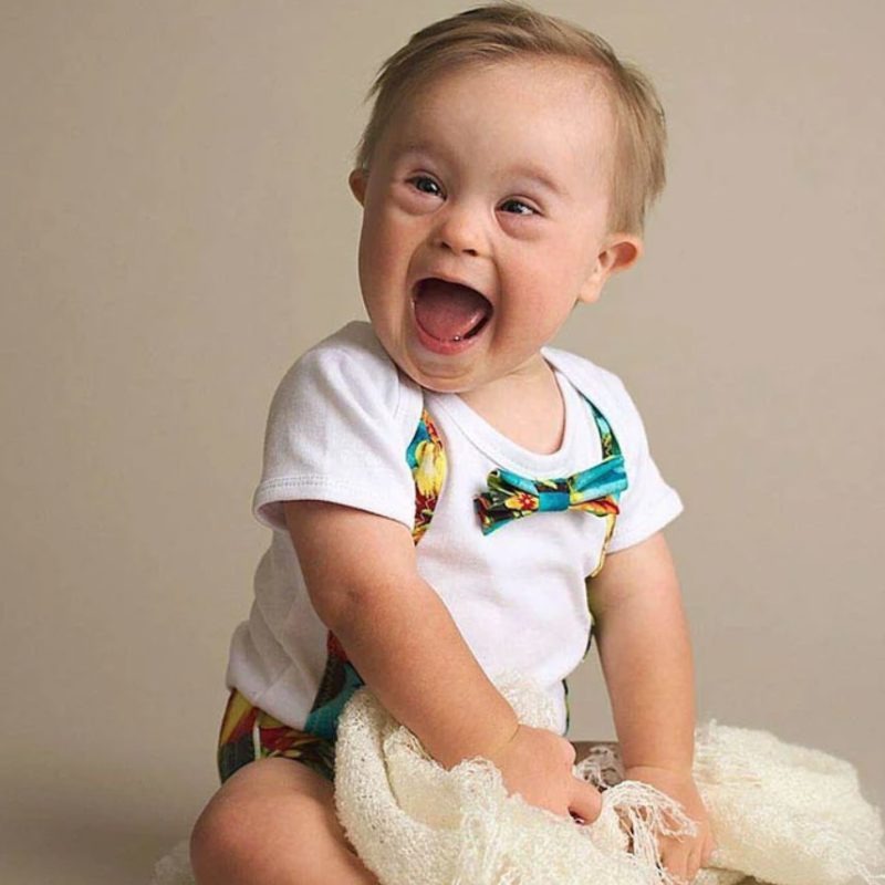 Serious health problems do not prevent this baby from being a model!
