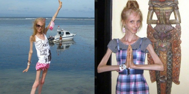 She's reached her breaking point! The life of a girl who weighs 23 kg