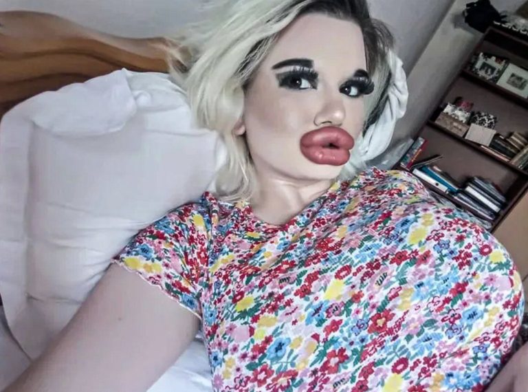 The girl's lips were enlarged 20 times! It hurts to eat now, but she's content because she believes she has the huge lips