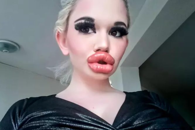 The girl's lips were enlarged 20 times! It hurts to eat now, but she's content because she believes she has the huge lips
