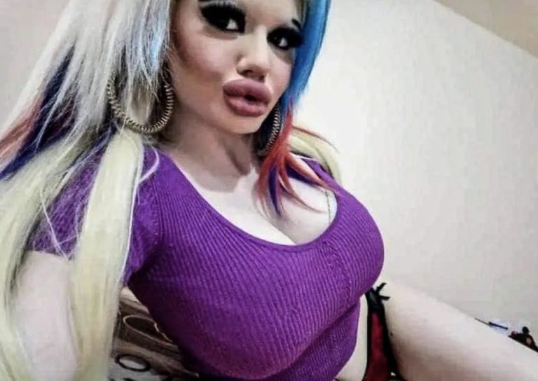 The girl's lips were enlarged 20 times! It hurts to eat now, but she's content because she believes she has the huge lips