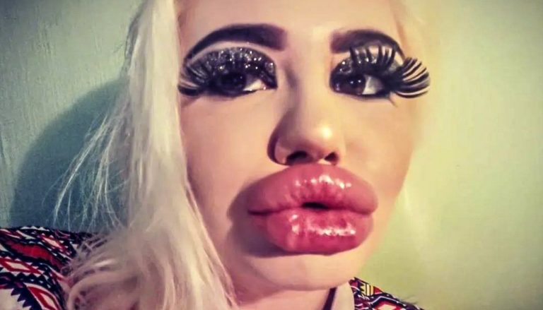 The girl's lips were enlarged 20 times! It hurts to eat now, but she's content because she believes she has the huge lips
