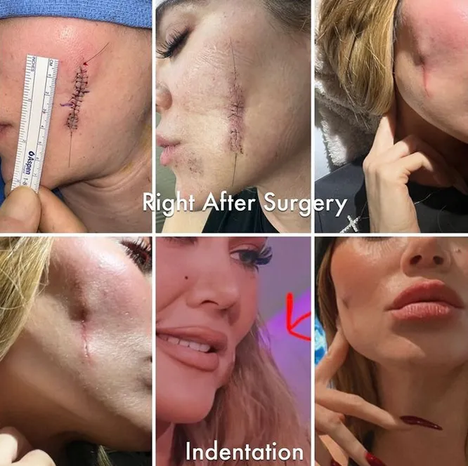 I look crazy! Khloe showed a dent on her cheek after melanoma removal
