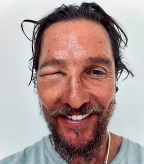Matthew McConaughey left fans worried after appearing with a huge black eye